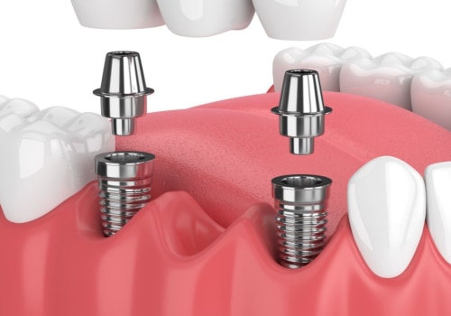 How dental implants are done?