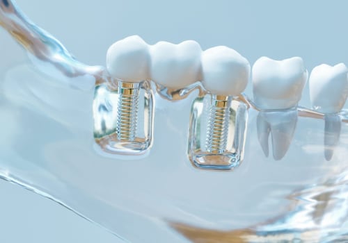 What are the most common causes of failure of dental implants?