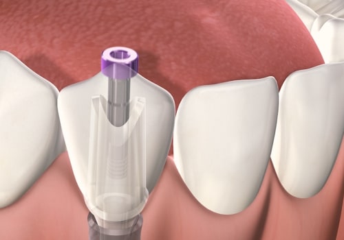 Why dental implants hurt?