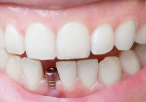 How quickly can dental implants be done?