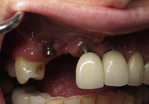How dental implants fail?
