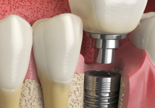 Why dental implants are good?