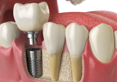 The Evolution of Dental Implants