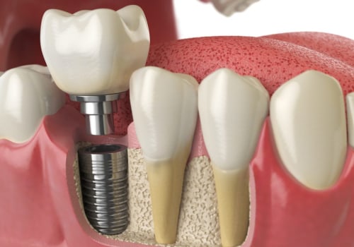 Why dental implants are not covered by insurance?