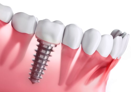 Where are dental implants done?