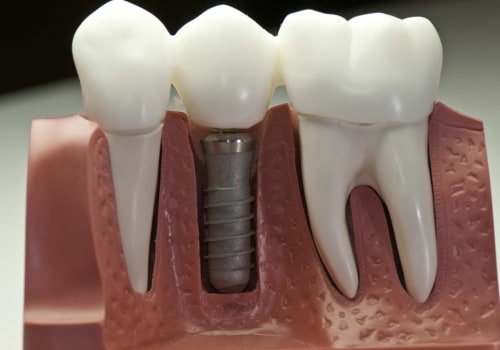 Is a Dental Implant Permanent