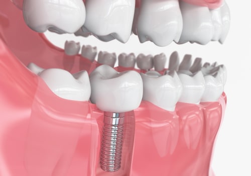 What Are the Two Main Types of Dental Implants