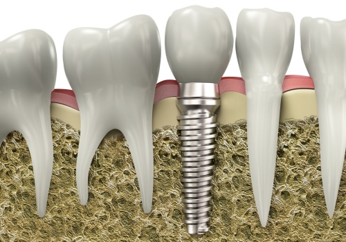 What makes you not a candidate for dental implants?