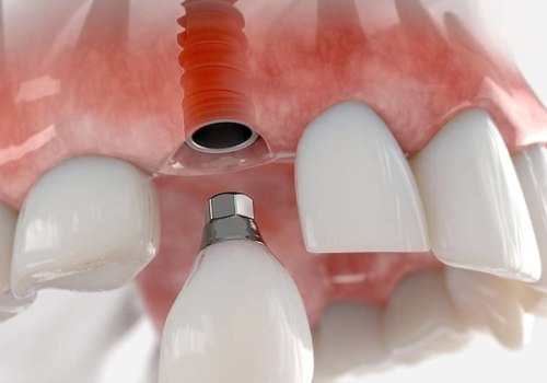 Who implants teeth?