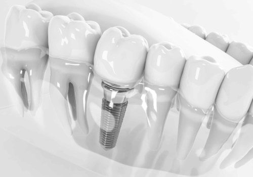 Transform Your Smile: The Advantages of Dental Implants
