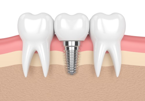 Dental Implants for Single Tooth Replacement