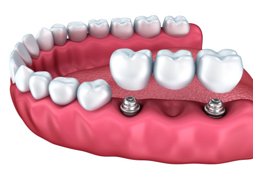 What are options instead of dental implants?