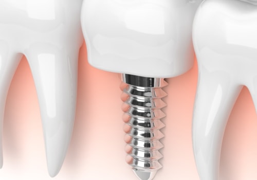 Who does dental implant work?