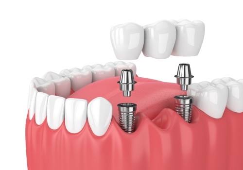 How long does pain last after dental implant?