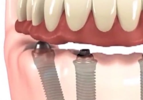 Who does dental implants?