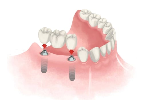Comprehensive Guide to Dental Implants