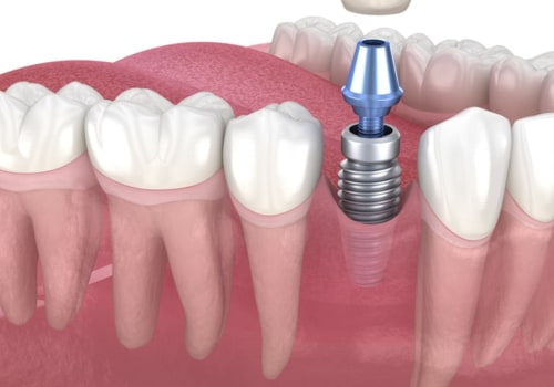 What are the downside of dental implants?