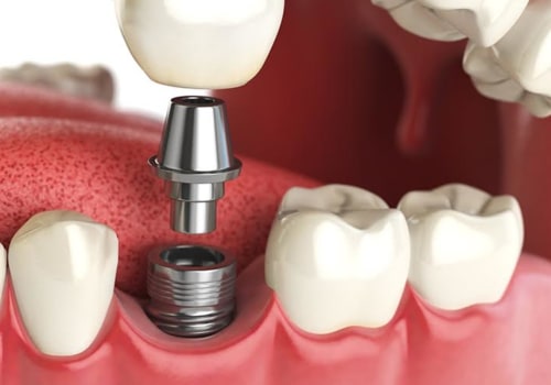 When are dental implants covered by insurance?